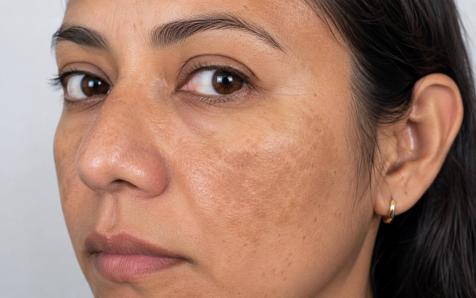 Antes Melasma