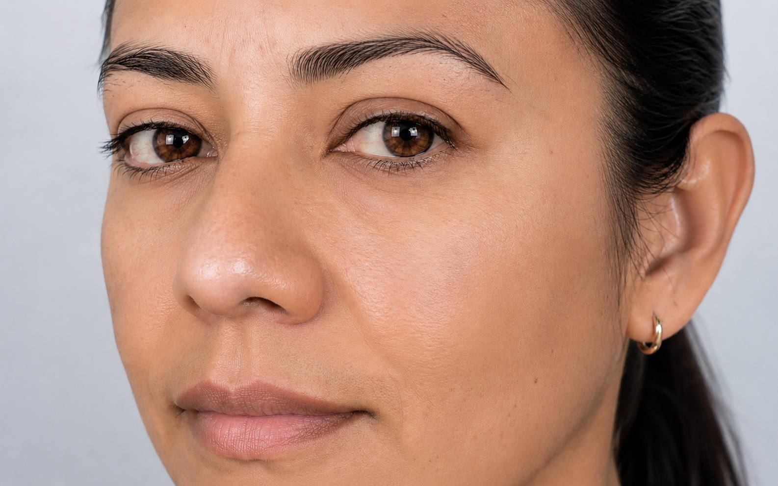 Después Melasma